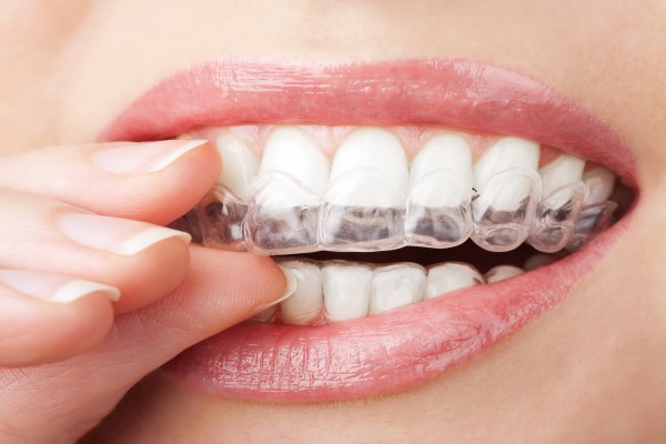 clear-aligners-2105