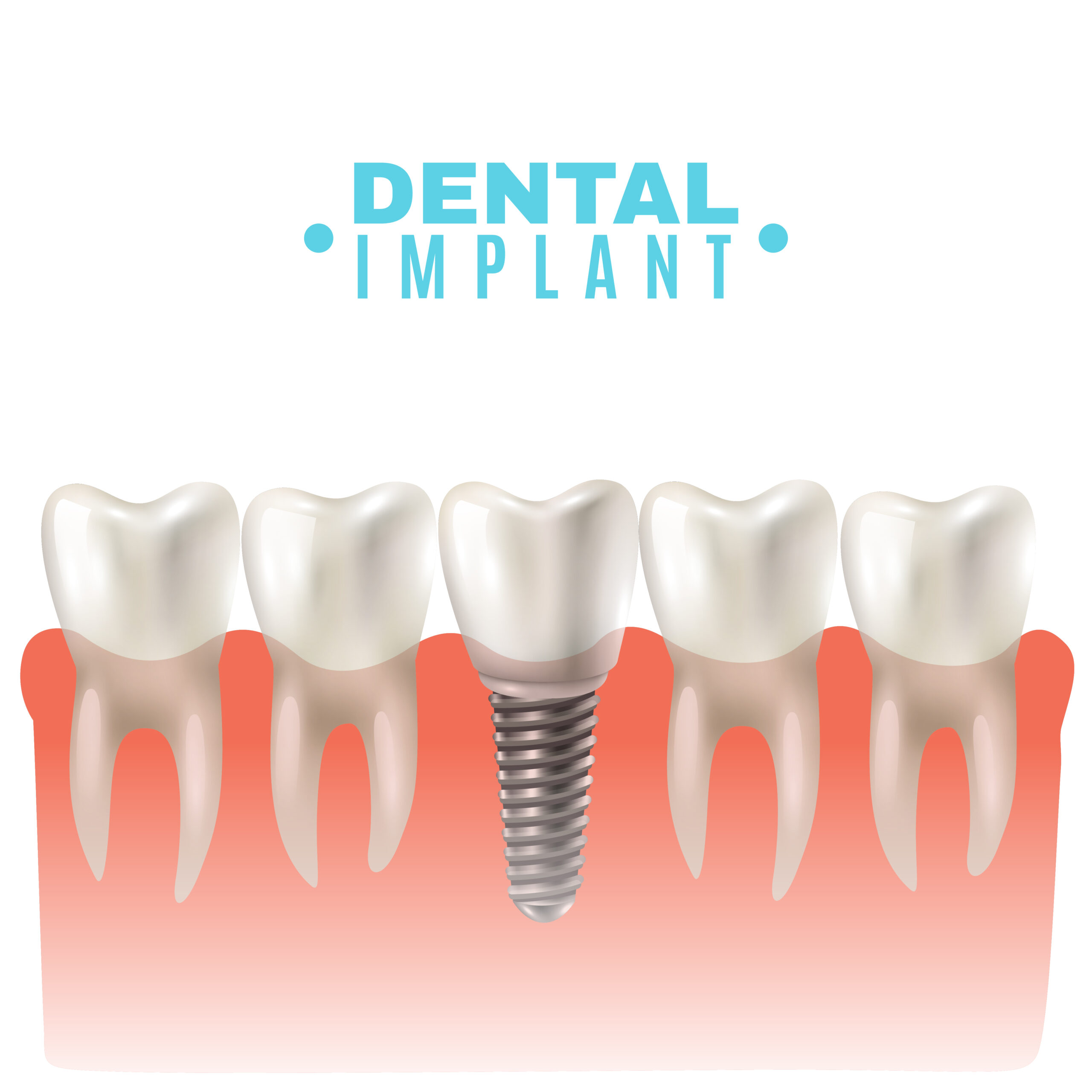 Dental implant model closeup cut away side view educative medical poster vector illustration