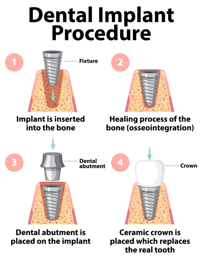 Infographic of human in structure of the dental implant Procedure